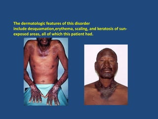 The dermatologic features of this disorder
include desquamation,erythema, scaling, and keratosis of sun-
exposed areas, all of which this patient had.
 