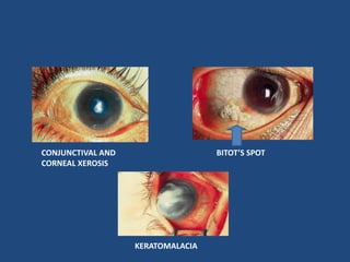 CONJUNCTIVAL AND
CORNEAL XEROSIS
BITOT’S SPOT
KERATOMALACIA
 