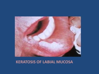 KERATOSIS OF LABIAL MUCOSA
 