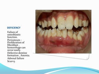 DEFICIENCY
Failure of
osteoblastic
function.
Periosteum :
Proliferation of
fibroblast ,
hemorrhage can
occur easily.
Defective dentine
formation , Anemia.
Adrenal failure
Scurvy.
 