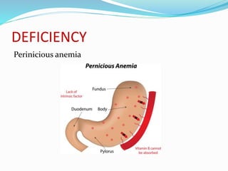 DEFICIENCY
Perinicious anemia
 
