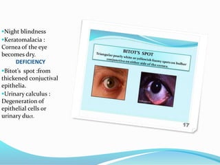 DEFICIENCY
Night blindness
Keratomalacia :
Cornea of the eye
becomes dry.
Bitot’s spot :from
thickened conjuctival
epithelia.
Urinary calculus :
Degeneration of
epithelial cells or
urinary duct.
 