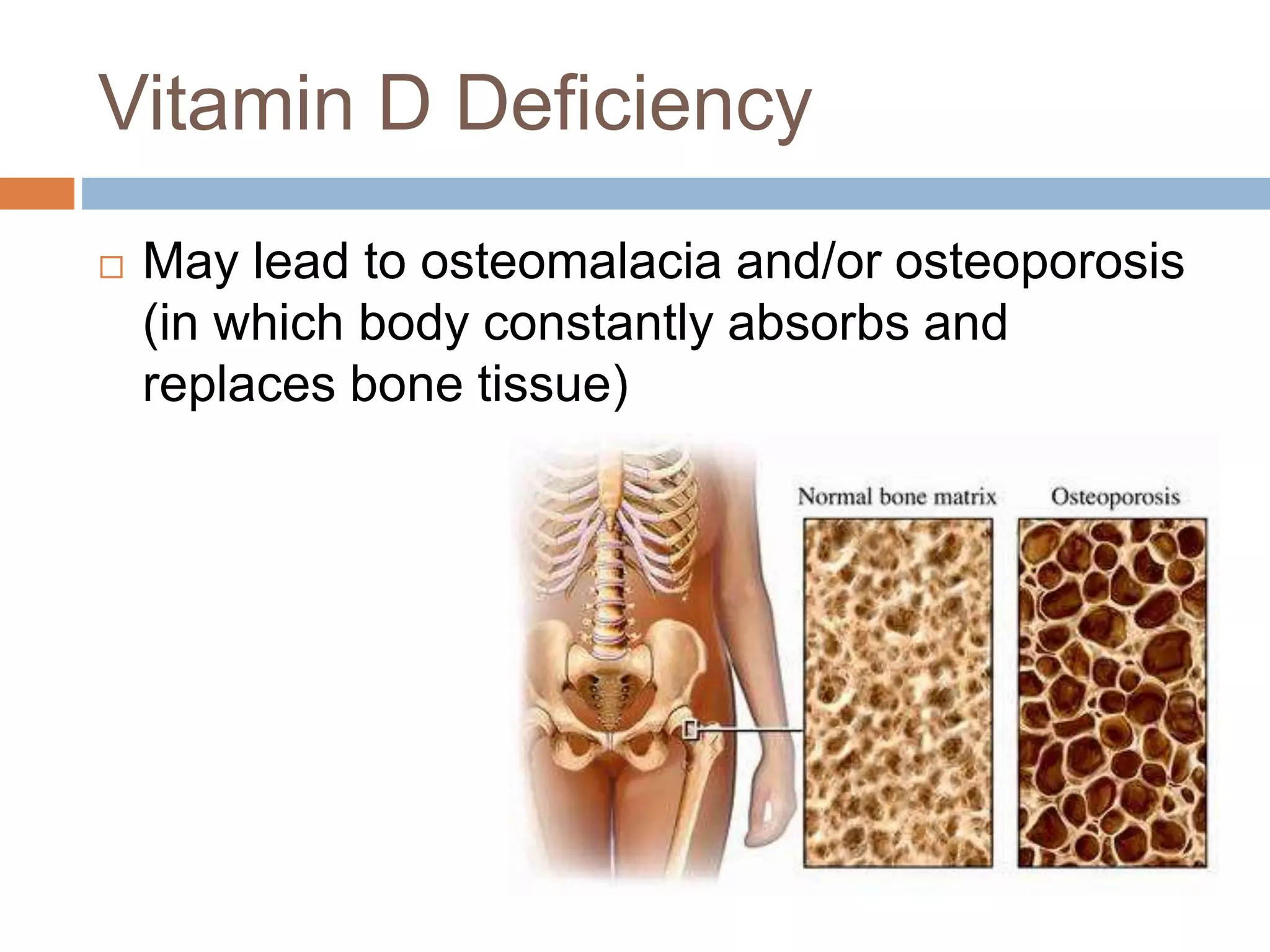Vitamin D Deficiency
 May lead to osteomalacia and/or osteoporosis
(in which body constantly absorbs and
replaces bone tissue)
 