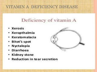 VITAMIN A DEFICIENCY DISEASE
 