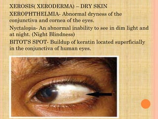 XEROSIS( XERODERMA) – DRY SKIN
XEROPHTHELMIA- Abnormal dryness of the
conjunctiva and cornea of the eyes.
Nyctalopia- An abnormal inability to see in dim light and
at night. (Night Blindness)
BITOT’S SPOT- Buildup of keratin located superficially
in the conjunctiva of human eyes.
 