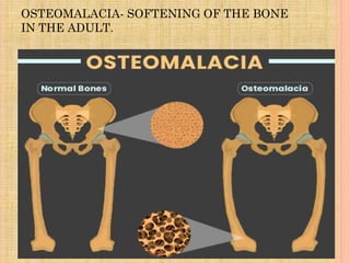 OSTEOMALACIA- SOFTENING OF THE BONE
IN THE ADULT.
 