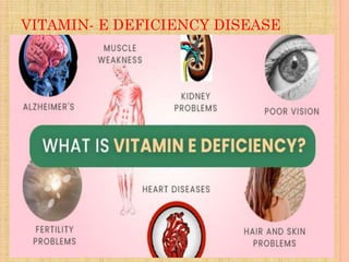 VITAMIN- E DEFICIENCY DISEASE
 