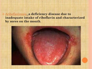  Ariboflavinosis- a deficiency disease due to
inadequate intake of riboflavin and characterized
by sores on the mouth.
 
