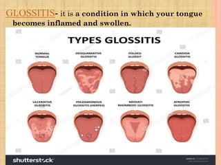 GLOSSITIS- it is a condition in which your tongue
becomes inflamed and swollen.
 