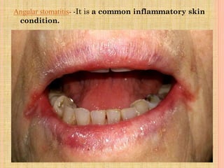 Angular stomatitis- -It is a common inflammatory skin
condition.
 