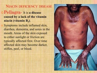 NIACIN DEFICIENCY DISEASE
Pellagra- It is a disease
caused by a lack of the vitamin
niacin (vitamin B3).
 Symptoms include inflamed skin,
diarrhea, dementia, and sores in the
mouth. Areas of the skin exposed
to either sunlight or friction are
typically affected first. Over time
affected skin may become darker,
stiffen, peel, or bleed.
 