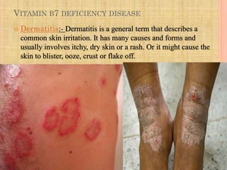 VITAMIN B7 DEFICIENCY DISEASE
 Dermatitis:- Dermatitis is a general term that describes a
common skin irritation. It has many causes and forms and
usually involves itchy, dry skin or a rash. Or it might cause the
skin to blister, ooze, crust or flake off.
 