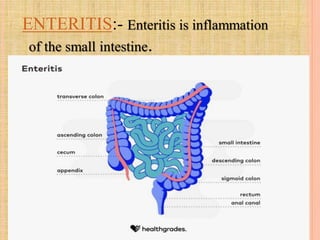ENTERITIS:- Enteritis is inflammation
of the small intestine.
 
