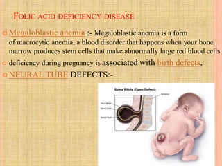 FOLIC ACID DEFICIENCY DISEASE
 Megaloblastic anemia :- Megaloblastic anemia is a form
of macrocytic anemia, a blood disorder that happens when your bone
marrow produces stem cells that make abnormally large red blood cells
 deficiency during pregnancy is associated with birth defects,
 NEURAL TUBE DEFECTS:-
 