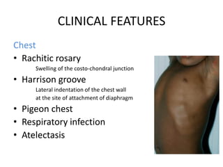 CLINICAL FEATURES
Chest
• Rachitic rosary
Swelling of the costo-chondral junction
• Harrison groove
Lateral indentation of the chest wall
at the site of attachment of diaphragm
• Pigeon chest
• Respiratory infection
• Atelectasis
 