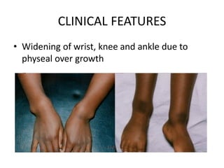 CLINICAL FEATURES
• Widening of wrist, knee and ankle due to
physeal over growth
 