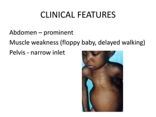 CLINICAL FEATURES
Abdomen – prominent
Muscle weakness (floppy baby, delayed walking)
Pelvis - narrow inlet
 