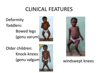 CLINICAL FEATURES
Deformity
Toddlers:
Bowed legs
(genu varum)
Older children:
Knock-knees
(genu valgum) windswept knees
 
