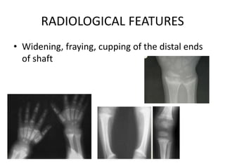 RADIOLOGICAL FEATURES
• Widening, fraying, cupping of the distal ends
of shaft
 