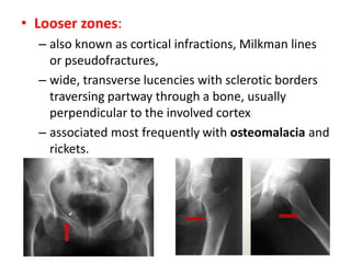 • Looser zones:
– also known as cortical infractions, Milkman lines
or pseudofractures,
– wide, transverse lucencies with sclerotic borders
traversing partway through a bone, usually
perpendicular to the involved cortex
– associated most frequently with osteomalacia and
rickets.
 