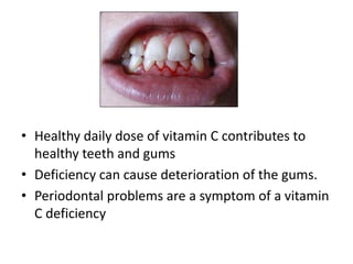 • Healthy daily dose of vitamin C contributes to
healthy teeth and gums
• Deficiency can cause deterioration of the gums.
• Periodontal problems are a symptom of a vitamin
C deficiency
 