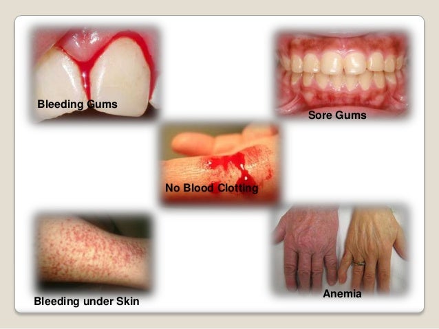 Bleeding Gums
Sore Gums
Bleeding under Skin
Anemia
No Blood Clotting
 