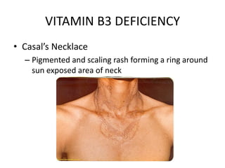 VITAMIN B3 DEFICIENCY
• Casal’s Necklace
– Pigmented and scaling rash forming a ring around
sun exposed area of neck
 