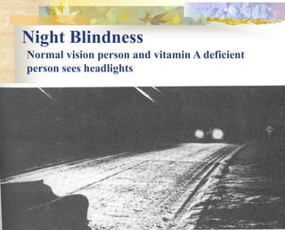 Night Blindness
Normal vision person and vitamin A deficient
person sees headlights
 