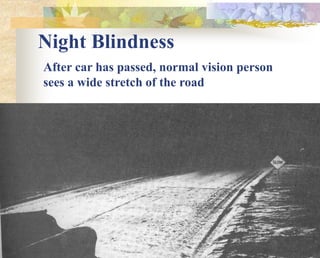 Night Blindness
After car has passed, normal vision person
sees a wide stretch of the road
 