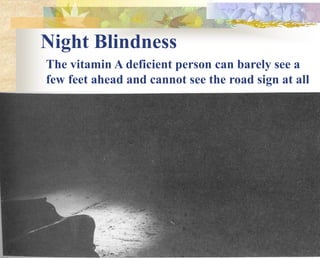 Night Blindness
The vitamin A deficient person can barely see a
few feet ahead and cannot see the road sign at all
 