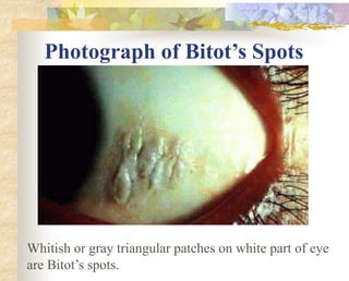 Whitish or gray triangular patches on white part of eye
are Bitot’s spots.
Photograph of Bitot’s Spots
 