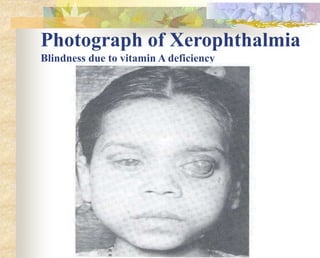 Photograph of Xerophthalmia
Blindness due to vitamin A deficiency
 