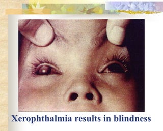 Xerophthalmia results in blindness
 