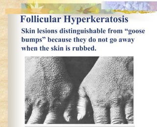 Follicular Hyperkeratosis
Skin lesions distinguishable from “goose
bumps” because they do not go away
when the skin is rubbed.
 