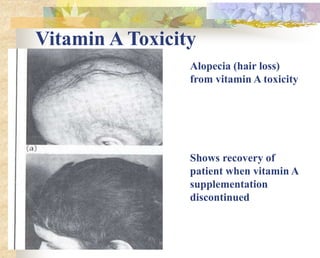 Vitamin A Toxicity
Alopecia (hair loss)
from vitamin A toxicity
Shows recovery of
patient when vitamin A
supplementation
discontinued
 