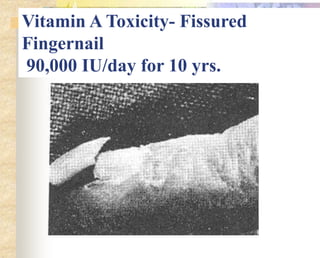 Vitamin A Toxicity- Fissured
Fingernail
90,000 IU/day for 10 yrs.
 