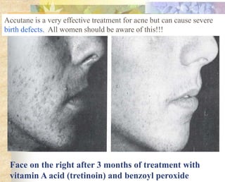 Vitamin A Toxicity – Acne (7)
Face on the right after 3 months of treatment with
vitamin A acid (tretinoin) and benzoyl peroxide
Accutane is a very effective treatment for acne but can cause severe
birth defects. All women should be aware of this!!!
 