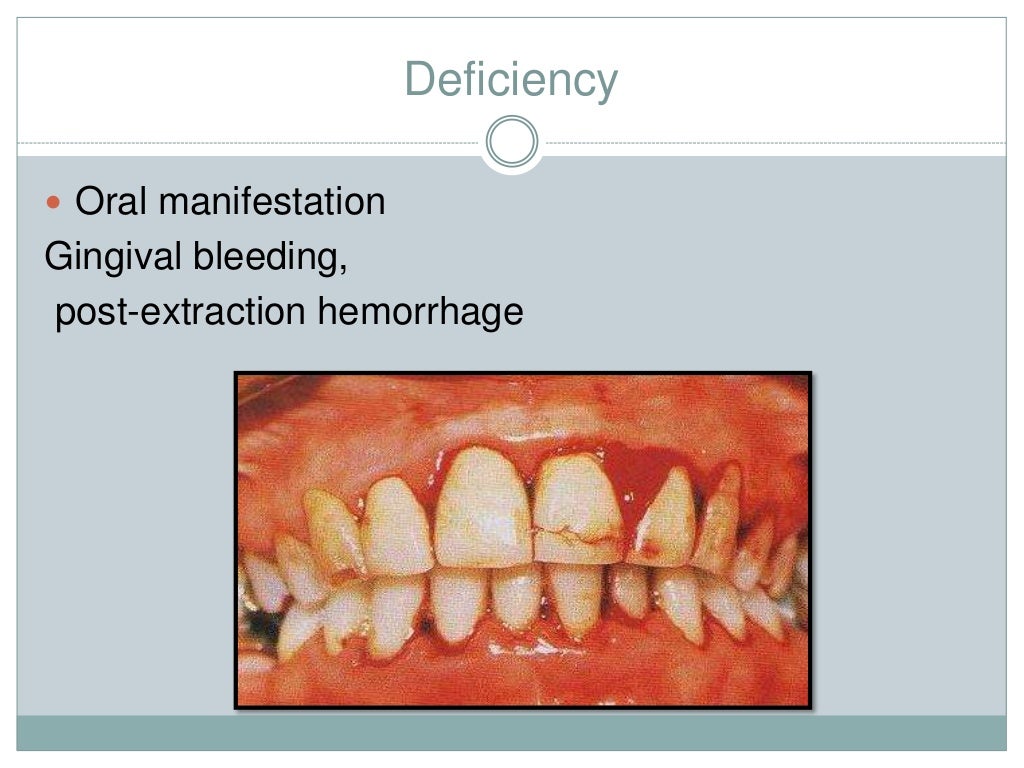 Vitamins and its oral manifestations