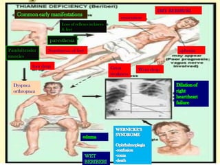 Loss of reflexes in knees
& feet
Numbnesss of feet
DRY BERIBERI
emaciation
aphonia
Wrist dropGreat
weakness
Dyspnea
orthropnea
foot drop
 