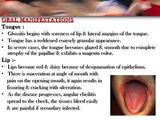 ORAL MANIFESTATIONSORAL MANIFESTATIONS
Tongue :Tongue :
• Glossitis begins with soreness of lip & lateral margins of the tongue.Glossitis begins with soreness of lip & lateral margins of the tongue.
• Tongue has a reddened coarsely granular appearance.Tongue has a reddened coarsely granular appearance.
• In severe cases, the tongue becomes glazed & smooth due to completeIn severe cases, the tongue becomes glazed & smooth due to complete
atrophy of the papillae & exhibits a magenta color.atrophy of the papillae & exhibits a magenta color.
Lip :-Lip :-
• Lips become red & shiny because of desquamation of epithelium.Lips become red & shiny because of desquamation of epithelium.
• There is maceration at angle of mouth withThere is maceration at angle of mouth with
pain on the opening mouth, it again results inpain on the opening mouth, it again results in
fissuring & cracking with ulceration.fissuring & cracking with ulceration.
• As the disease progresses, angular cheilitisAs the disease progresses, angular cheilitis
spread to the cheek, the tissues bleed easilyspread to the cheek, the tissues bleed easily
& are painful if secondary infected.& are painful if secondary infected.
 