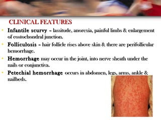 CLINICAL FEATURESCLINICAL FEATURES
• Infantile scurvyInfantile scurvy – lassitude, anorexia, painful limbs & enlargement– lassitude, anorexia, painful limbs & enlargement
of costochondral junction.of costochondral junction.
• FolliculosisFolliculosis – hair follicle rises above skin & there are perifollicular– hair follicle rises above skin & there are perifollicular
hemorrhage.hemorrhage.
• HemorrhageHemorrhage may occur in the joint, into nerve sheath under themay occur in the joint, into nerve sheath under the
nails or conjunctiva.nails or conjunctiva.
• Petechial hemorrhagePetechial hemorrhage occurs in abdomen, legs, arms, ankle &occurs in abdomen, legs, arms, ankle &
nailbeds.nailbeds.
 