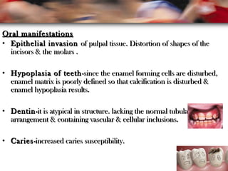 Oral manifestationsOral manifestations
• Epithelial invasionEpithelial invasion of pulpal tissue. Distortion of shapes of theof pulpal tissue. Distortion of shapes of the
incisors & the molars .incisors & the molars .
• Hypoplasia of teethHypoplasia of teeth-since the enamel forming cells are disturbed,-since the enamel forming cells are disturbed,
enamel matrix is poorly defined so that calcification is disturbed &enamel matrix is poorly defined so that calcification is disturbed &
enamel hypoplasia results.enamel hypoplasia results.
• DentinDentin-it is atypical in structure. lacking the normal tubular-it is atypical in structure. lacking the normal tubular
arrangement & containing vascular & cellular inclusions.arrangement & containing vascular & cellular inclusions.
• CariesCaries-increased caries susceptibility.-increased caries susceptibility.
 