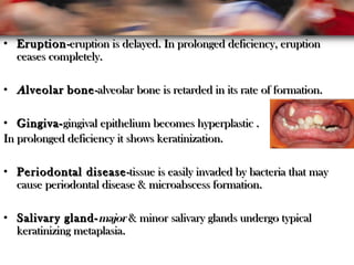 • EruptionEruption-eruption is delayed. In prolonged deficiency, eruption-eruption is delayed. In prolonged deficiency, eruption
ceases completely.ceases completely.
• AAlveolarlveolar bonebone-alveolar bone is retarded in its rate of formation.-alveolar bone is retarded in its rate of formation.
• Gingiva-Gingiva-gingival epithelium becomes hyperplastic .gingival epithelium becomes hyperplastic .
In prolonged deficiency it shows keratinization.In prolonged deficiency it shows keratinization.
• PeriodontalPeriodontal diseasedisease-tissue is easily invaded by bacteria that may-tissue is easily invaded by bacteria that may
cause periodontal disease & microabscess formation.cause periodontal disease & microabscess formation.
• Salivary gland-Salivary gland-majormajor & minor salivary glands undergo typical& minor salivary glands undergo typical
keratinizing metaplasia.keratinizing metaplasia.
 
