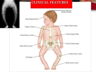 CLINICAL FEATURESCLINICAL FEATURES
 