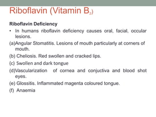 Riboflavin (Vitamin B2)
Riboflavin Deficiency
• In humans riboflavin deficiency causes oral, facial, occular
lesions.
(a)Angular Stomatitis. Lesions of mouth particularly at corners of
mouth.
(b) Cheliosis. Red swollen and cracked lips.
(c) Swollen and dark tongue
(d)Vascularization of cornea and conjuctiva and blood shot
eyes.
(e) Glossitis. Inflammated magenta coloured tongue.
(f) Anaemia
 