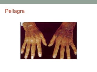 Pellagra
 