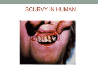 SCURVY IN HUMAN
 