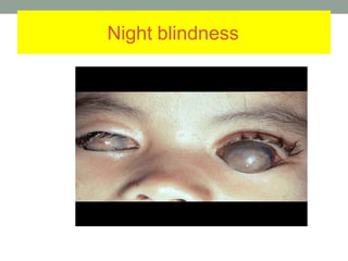 Night blindness
 