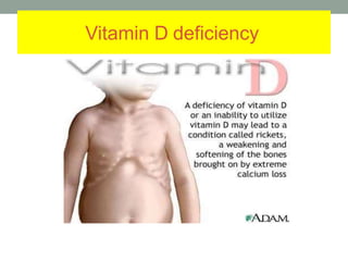 Vitamin D deficiency
 