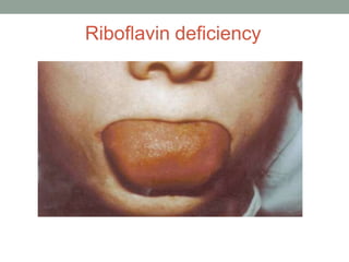 Riboflavin deficiency
 